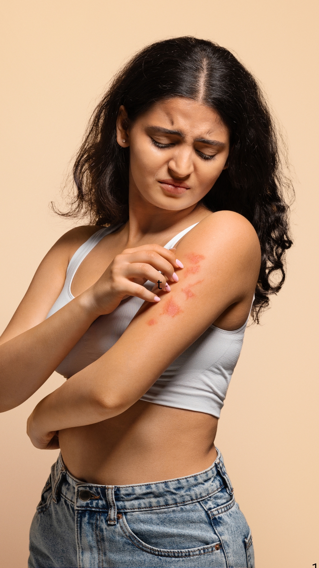 psoriasis treatment in bangalore