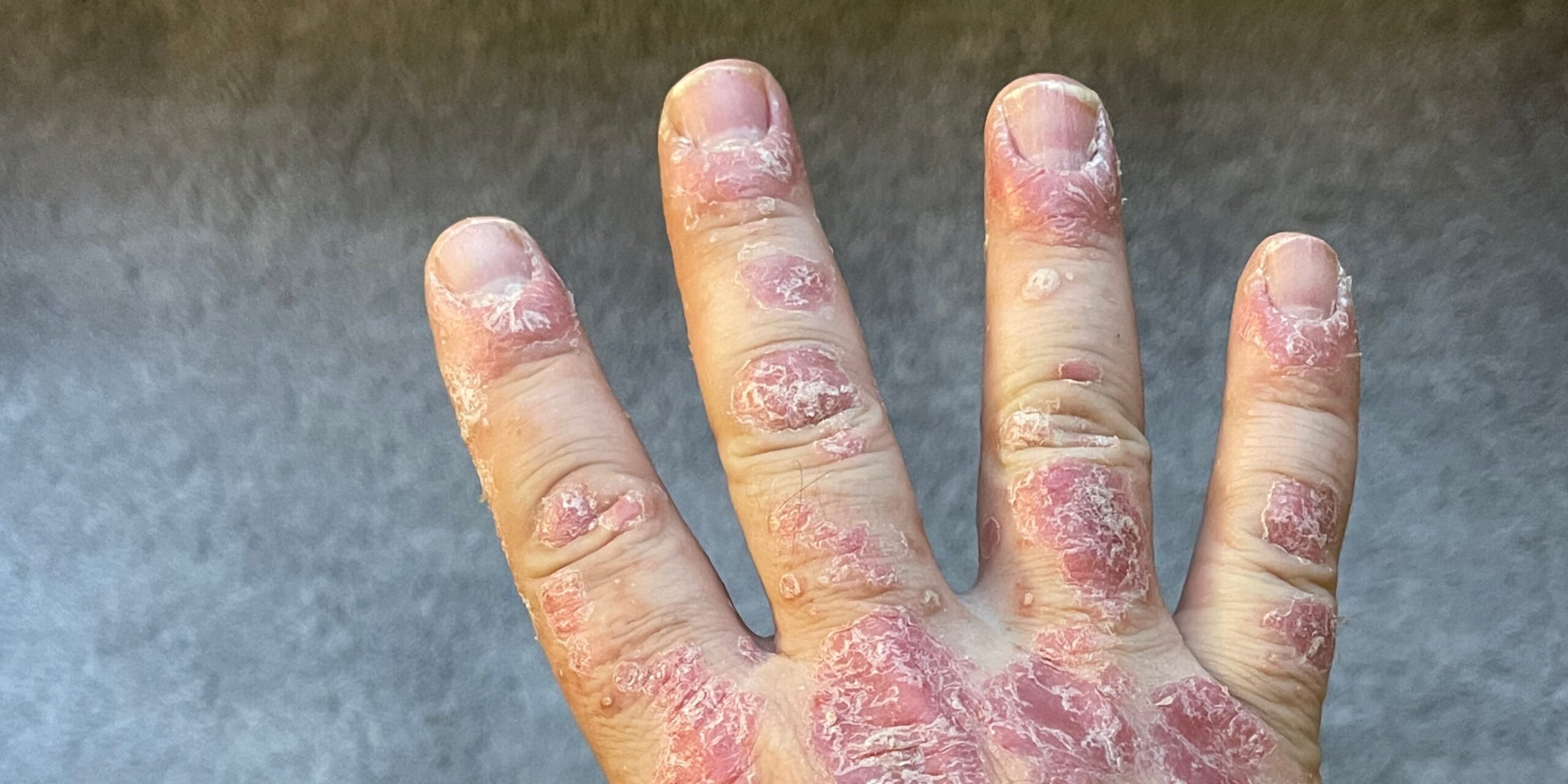 Nail Psoriasis Treatment in hsr