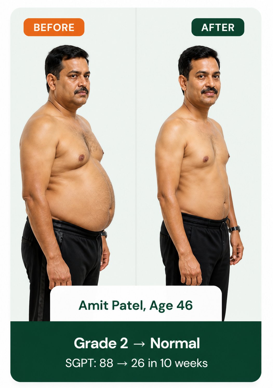 Neha Iyer before and after fatty liver reversal