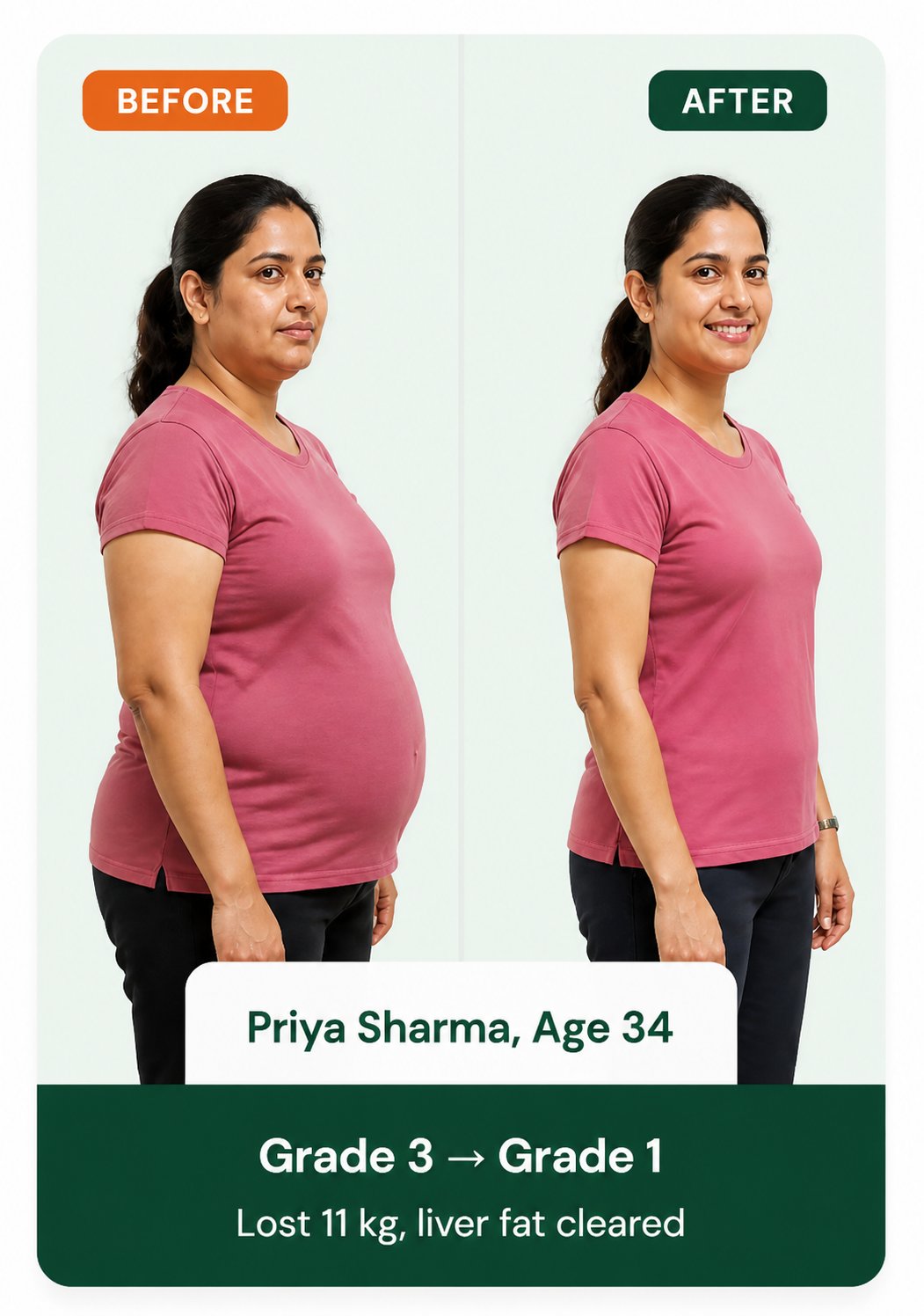 Sandeep Verma before and after fatty liver reversal